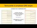 10d tachycardie  qrs larges ecg presentation du vt score dr taboulet