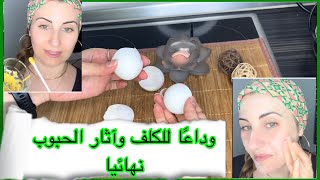 وداعًا للكلف وآثارالحبوب  نهائيًا وكولاجين طبيعي  Pigmentation treatment ،Natural collagen