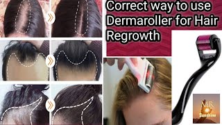 How to use Dermaroller for Hair Regrowth at home#Dermaroller for hair loss