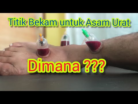 Ciri-Ciri Kolesterol dan Asam Urat Tinggi | DokterSehat. 