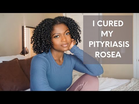 HOW TO CURE PITYRIASIS ROSEA | Get Rid of PITYRIASIS for GOOD| STORY TIME | CURED AFTER 5  MONTHS