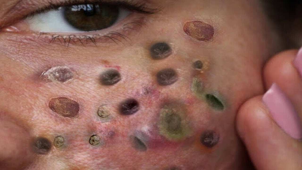 TREATMENT OF BLACKHEADS AND HIDDEN ACNE FOR THE ELDERLY Satisfying