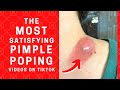 Pimple Popping - The Most Satisfying Pimple Popping Videos we Found on Tiktok
