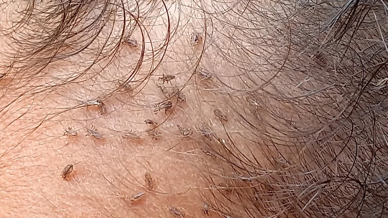 CABEÇA CHEIA DE PIOLHOS E LÊNDEAS. - YouTube