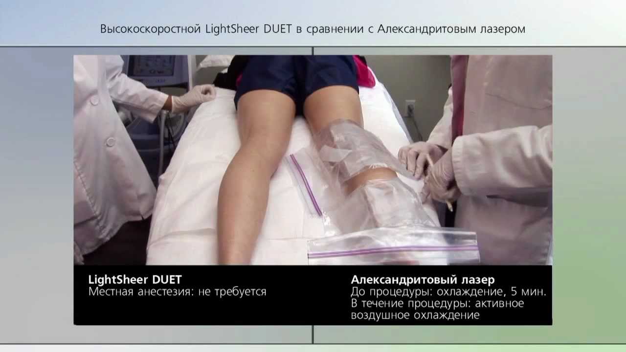 LightSheer DUET vs Александритовый лазер. Сравнение аппаратов.