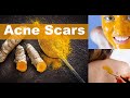 How I Got Rid Of My ACNE SCARS !THE TURMERIC MASK THAT CLEARED MY ACNE SCARS AND HYPER PIGMENTATION!