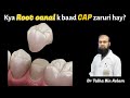 Tooth capdental crown after root canal treatment or rct is it important by dr talha bin aslam