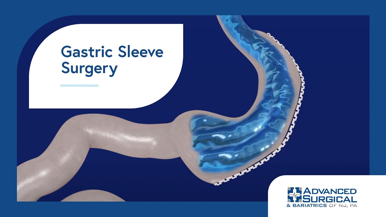 Gastric Sleeve Surgery for Weight Loss, Bariatric Services