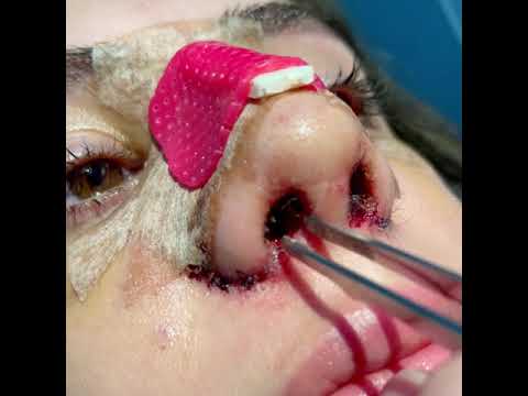 Splint removal rhinoplasty.  #rhinoplasty  #rinoplastika  #rinoplastica  ринопластика   #nosejob