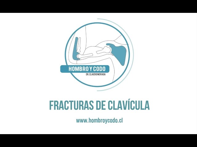 Hombro: Fractura clavicula