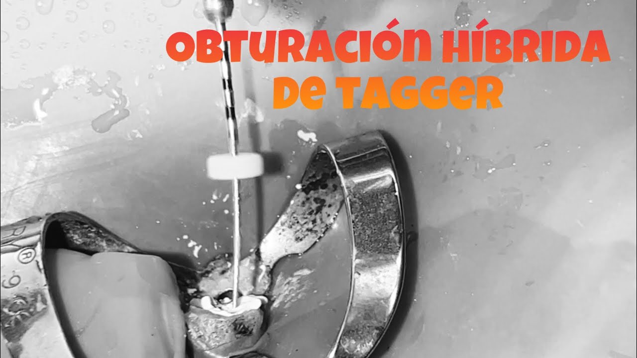 Técnica híbrida de tagger / termomecánica canino superior - YouTube