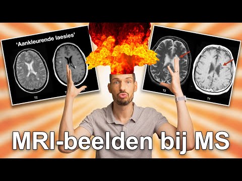 Video: Multiple Sclerose MRI-beelden Van De Hersenen