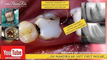 squirting obturation on radix entomolaris - perawatan gigi berlubang dokter gigi konservasi
