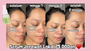 Review Jujur Serum Jerawat LOKAL terampuh buat jerawat meradang ♥️ | BYT Acne Serum