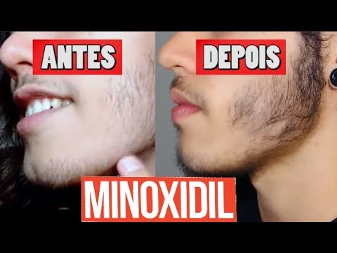 Minoxidil a 5% d\u00e1 certo? Funciona? Barba - V\u00eddeo Evolutivo ...