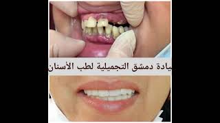 عيادة دمشق التجميلية لطب الأسنان في سلطنة عمان ?? ولاية عبري الواقعة مقابل اللولو القديم  ٧٩٢٢٠٧٠٣