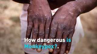 How dangerous is Monkeypox?