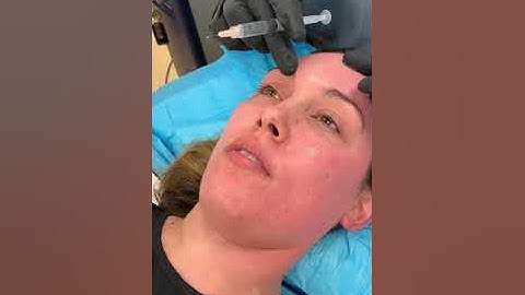 How to get full face anesthesia for lasers and chemical peels with nerve blocks