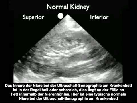 Video: Wer behandelt Hydronephrose?