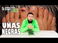 PORQUE SE PONEN LAS UÑAS NEGRAS. Consultorio 153 💅.