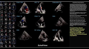 BrainX Community Live! December 2024: Automating Echocardiography with Echoprime