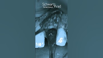 Horizontal Onlay Bone Graft in the esthetic zone with intraoral autologous bone - Case 2