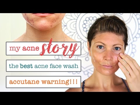 MY ACNE STORY // HOMEMADE ACNE FACE WASH // DON&#;T TAKE ACCUTANE UNTIL YOU WATCH THIS