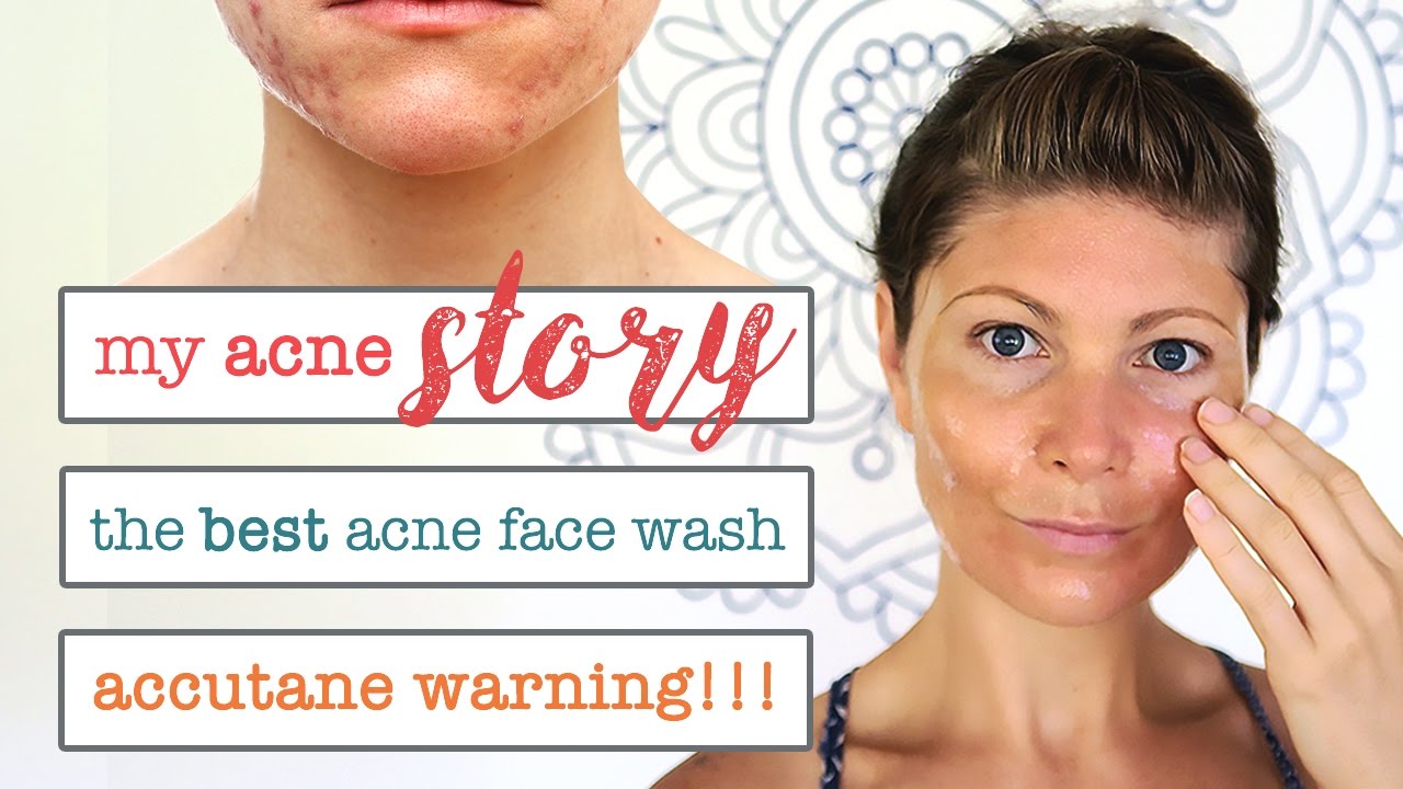 MY ACNE STORY // HOMEMADE ACNE FACE WASH // DON'T TAKE ACCUTANE UNTIL