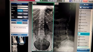 How to create x-ray LS spine AP lateral view CR pinter HD quality picture new updat 2018!!