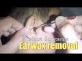 Piece by Piece Earwax Extraction with Lighted Ear Curette