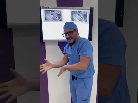 ما يجب ان تعرفيه جيدا عن اصلاح فتق جرح القيصريه