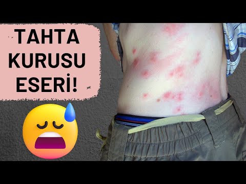 Tahta Kurusu Isırığı Nasıl Geçer? | Tahta Kurusu Isırığına Ne İyi Gelir? | Evde Yap | TREND HABER