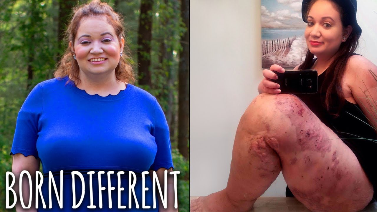 I’ve Had 50 Surgeries On My Giant Leg | BORN DIFFERENT