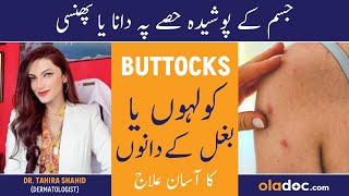 HOW TO REMOVE BUTTOCKS ACNE - Baghal Men Dana Nikalna - Hips/Underarm Pimple Treatment In Urdu/Hindi screenshot 2