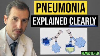 Pneumonia Explained! Symptoms, Diagnosis, Labs, Treatment