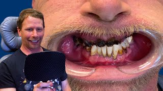 Man Goes From Black Teeth To New Smile In 24 hours | Dental Implants