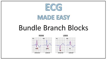 ECG | Bundle Branch Blocks | Trick to remember