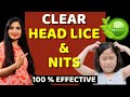 How to remove head lice   nits  treat lice without chemicals  natural remedy headlice haircare