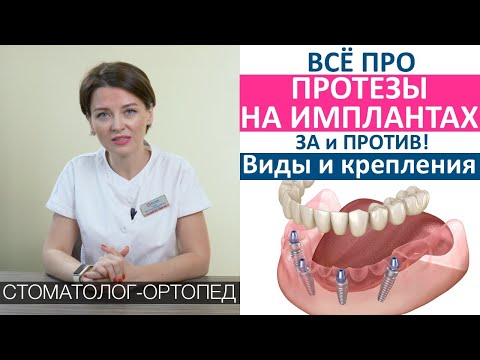 Протезы на имплантах при полной потере зубов. All on 4. Крепления протезов, виды протезов