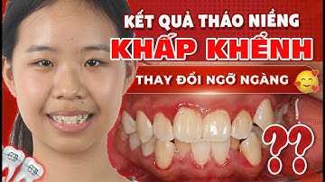 Tháo Niềng Răng Khấp Khểnh Cho Phương Anh – Nụ Cười Mới Khiến Phụ Huynh Ngỡ Ngàng| Nha khoa Sdental