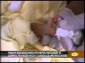 Queman pie a recién nacida y tuvieron que amputarle un dedo en hospital de Vista Alegre