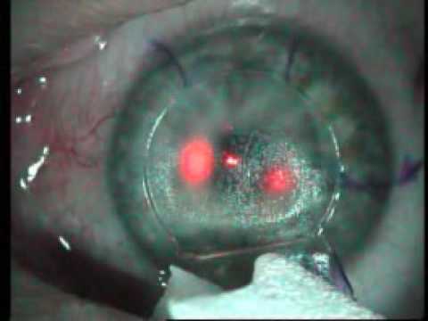 Lasik Eye Surgery Procedure Video