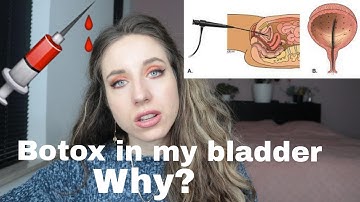 I did botox in my bladder - Why? | My experience - 1 month