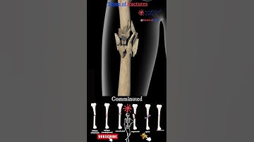 Types of bone fractures 🦴 bone fractures