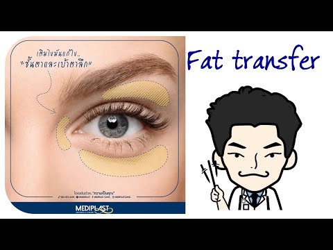 Fat Transfer การฉีดไขมันบริเวณเบ้าตา|About Surgery EP1