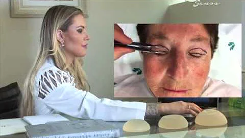 Como fazer cirurgia da pálpebras?