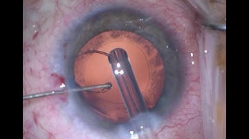 Capsular Tension Ring (CTR) Insertion Pearls/Tips - Using a Sinskey Hook