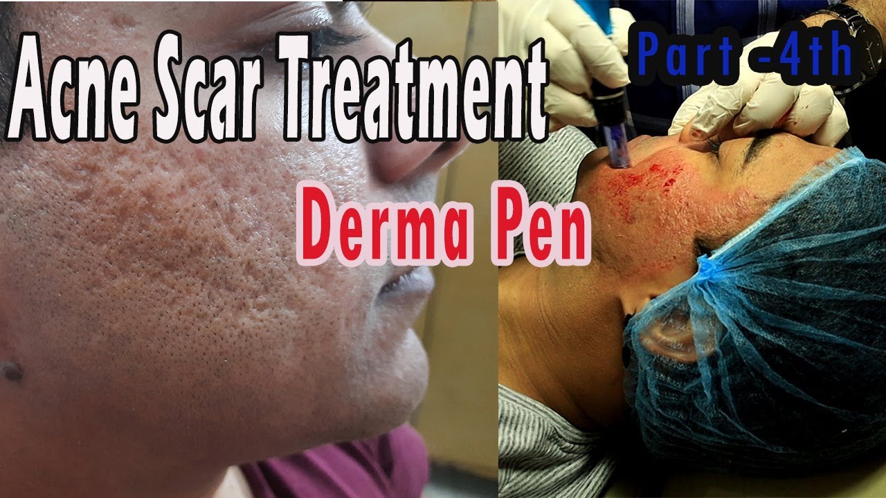 Acne Scar Treatment Derma Pen MicroKneadlingHow to Remove Acne/Pimples Scar, MarkPart 4