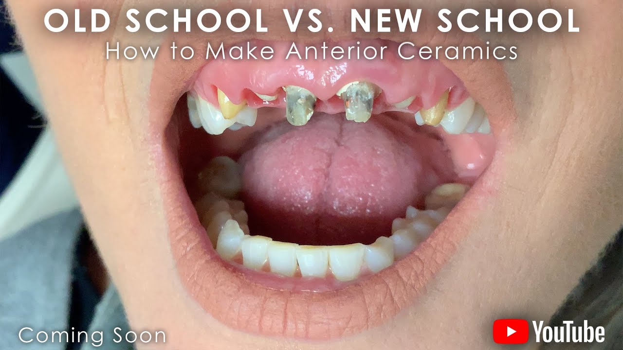 Old School vs. New School: How to make Anterior Ceramics