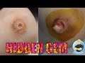 SUPER DEEP HEEL WART FINALLY BEING EXPOSED ***PREPARED TO BE SHOCKED***